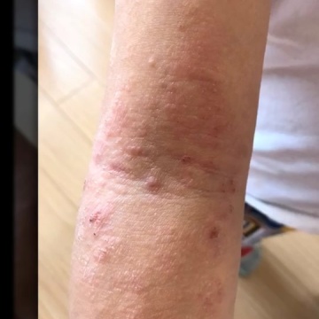 特应性皮炎