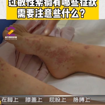 过敏性紫癜